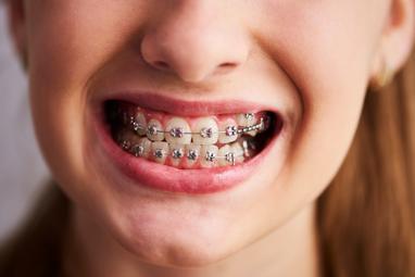 Dental Braces: Achieving a Beautiful Smile and Caring for Your Teeth